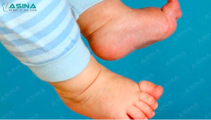 Bé bị chân dài chân ngắn: Nguyên nhân và cách khắc phục