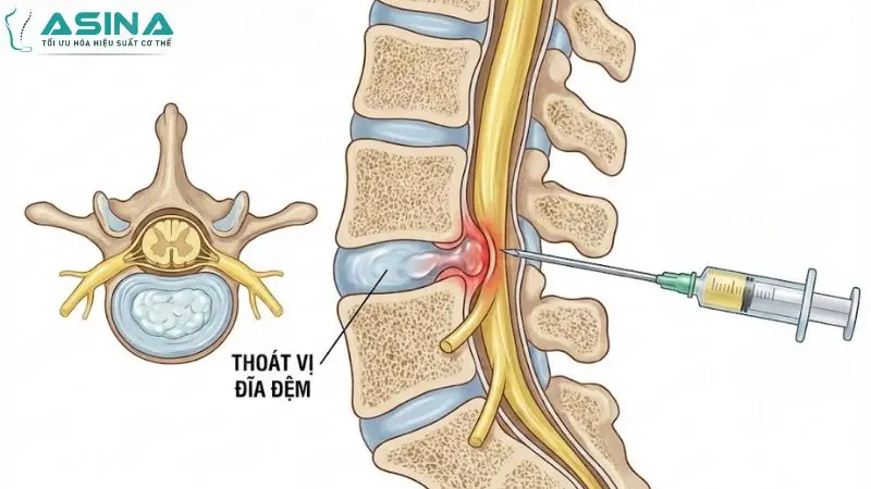 Đánh giá toàn diện: Tiêm màng cứng thoát vị đĩa đệm có hại không?